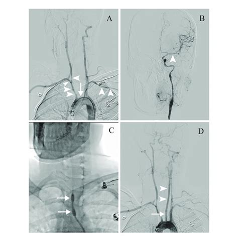 The Endovascular Therapy Procedure A Dsa Showing Multiple Stenoses