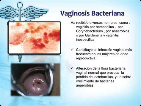 Infecciones Del Tracto Genital Inferior Ppt