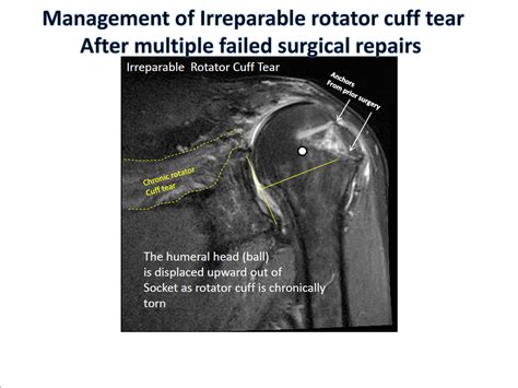 New Approaches In RSA Boston Shoulder Institute