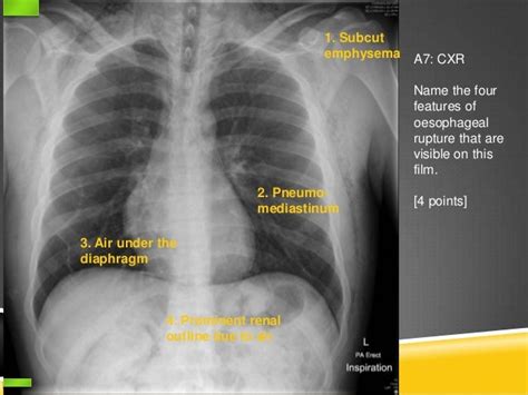 Oesophageal Rupture