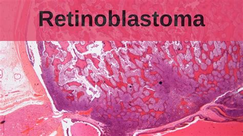 Retinoblastoma Pathology Mini Tutorial Youtube