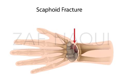Zaf Naqui | Scaphoid Fracture