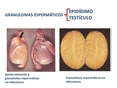 7 Anomalías Del Aparato Genital Masculino