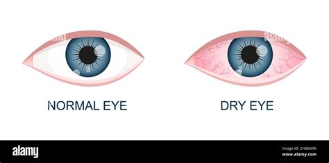 Uveitis Vs Conjunctivitis