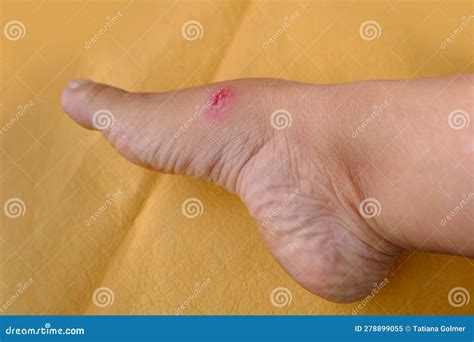 Closeup Of Weeping Wound Trophic Ulcer On Female Leg Wound Exudate Prevents Healing Ulcers By