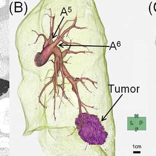 PDF Thoracoscopic Right Basilar Segmentectomy After Right Upper Lobectomy