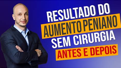 Como fica após o AUMENTO PENIANO sem cirurgia ANTES E DEPOIS Dr