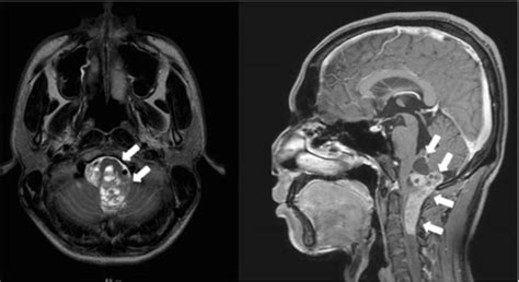 Ependymoma | Concise Medical Knowledge