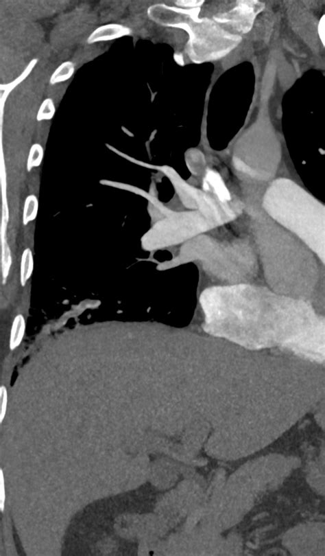 Pulmonary Embolus And Infarct Image