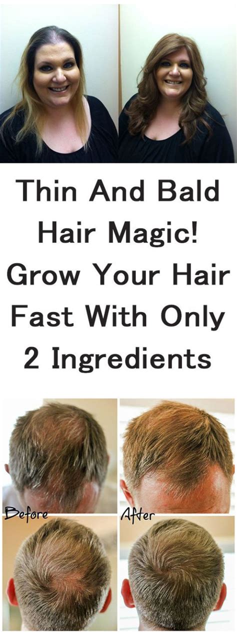 The Best Way To Regrow Hair On Bald Head Naturally Best Simple