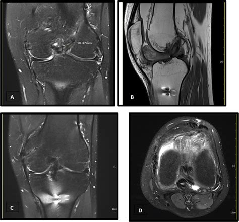 A-D, MRI examination showing cyclops lesion. A, MRI coronal T2 weighted ...