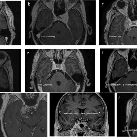 Examples Of Mri Scans A Patient No Axial T Gadolinium Mri B