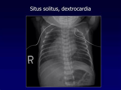 Approach To Cyanotic Congenital Heart Disease Ppt