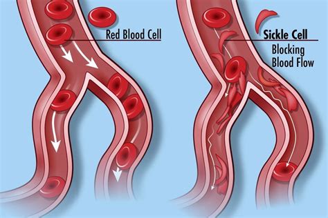 Sickle Cell Anemia Diagram Quizlet