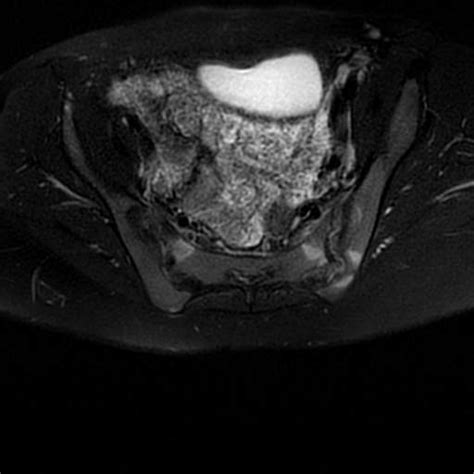 Acute Sacroiliitis Image