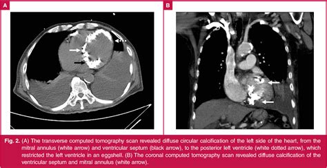 Figure From Restrictive Cardiomyopathy Caused By Diffuse