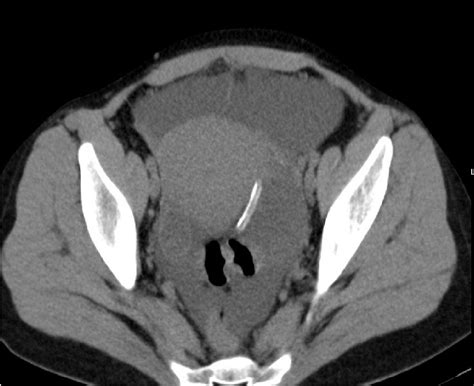 Figure From Primary Malfunction Of A Peritoneal Dialysis Catheter