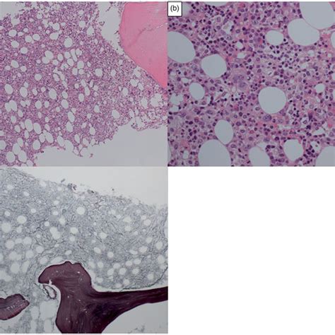 Bone Marrow Biopsy A Hematoxylin And Eosin Stain Low Power Field B