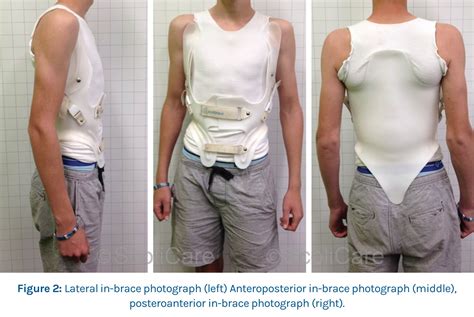 Case 16 Year Old Male Adolescent Patient ScoliBrace