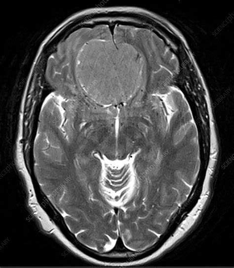 Olfactory Groove Meningioma Mri Stock Image C0394264 Science