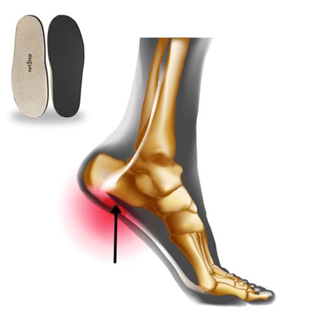 Custom Plantar Fasciitis Orthotics - Netstep