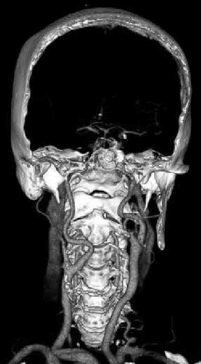 Computed Tomography Angiography Reconstruction Showing Elongation And Download Scientific