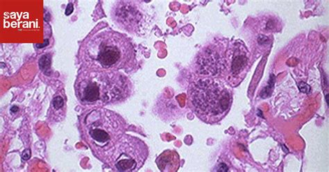 Cytomegalovirus Itu Apa Sih Saya Berani
