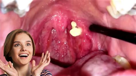 Tonsil Stones How To Remove Tonsil Stones Tonsillolith Youtube