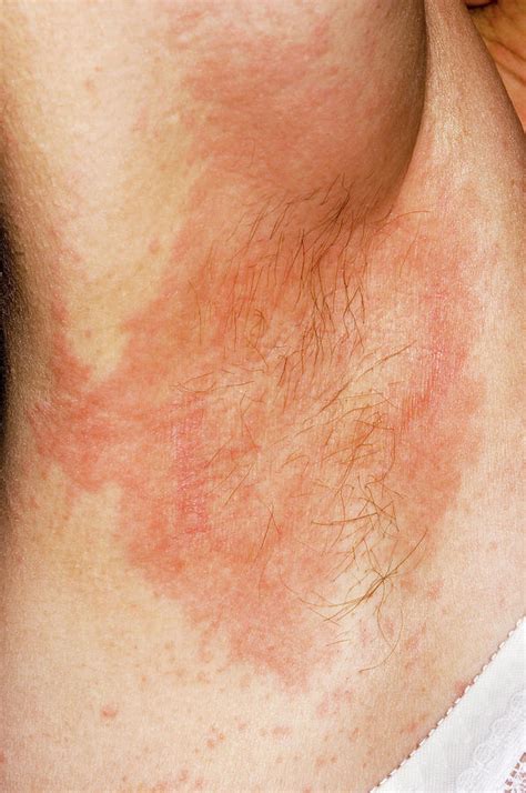 Urticaria Rash Photograph By Dr P Marazzi Science Photo Library