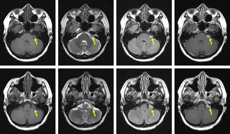 CPA meningioma – Radiology Cases