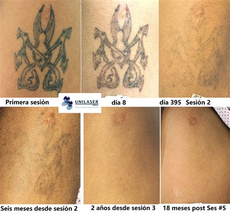 Remoci N De Tatuajes Con L Ser Unilaser M Dica