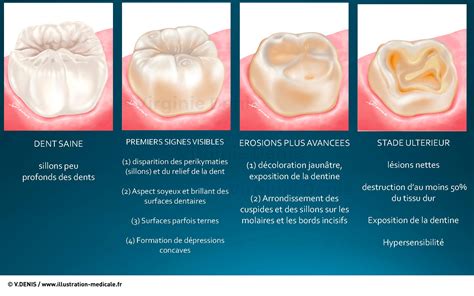 Erosion Dentaire Illustration Médicale