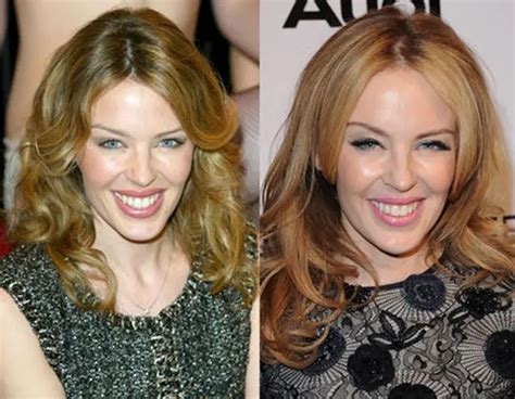 Kylie Minogue Plastic Surgery Before and After Botox Injections | Celebie