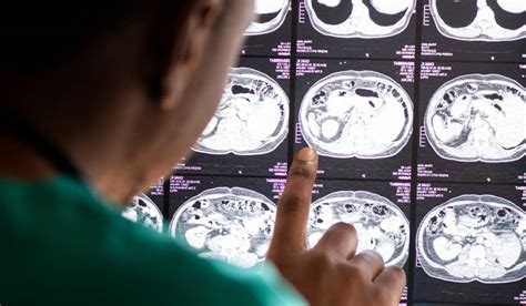 Cómo Funciona El Lecanemab Medicamento Contra El Alzheimer