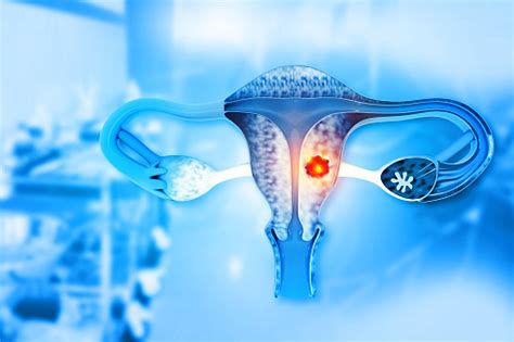 Female Reproductive System Diseases Uterus Cancer And Endometrial