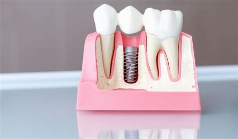 Surprising Benefits Of Dental Implants Narre Warren Dental Care