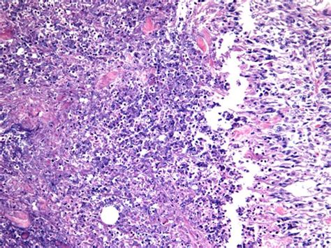 Pathology Outlines Anaplastic Carcinoma