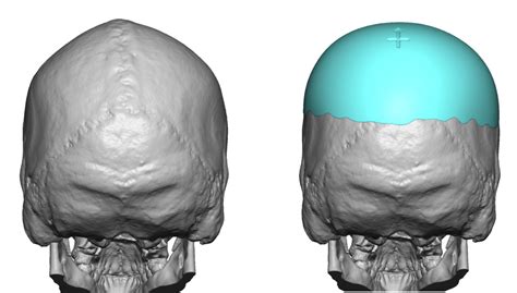 Plastic Surgery Case Study Custom Skull Implant For Correction Of