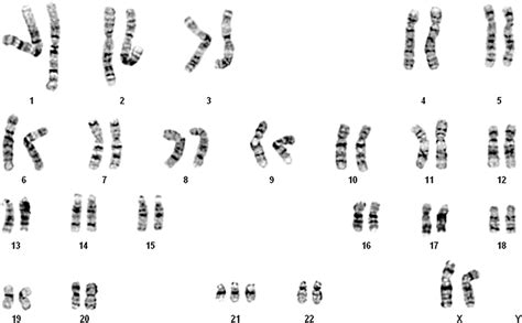 A Karyotype Of 47xxþ21 Download Scientific Diagram