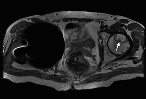 Avascular necrosis – MRI - Radiology at St. Vincent's University Hospital