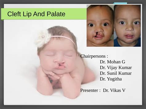 Genetic Of Nonsyndromic Cleft Lip And Palate