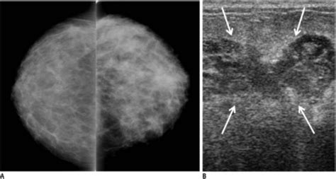 Puerperal Mastitis With Abscess Secondary To Staphyloco Open I