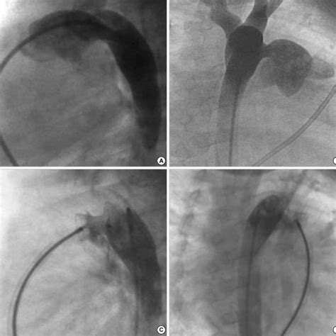 Aortogram In Lateral A And Right Anterior Oblique View B Displaying Download Scientific