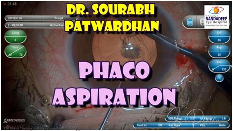 Teaching Video Phaco Aspiration The Method Dr Sourabh Patwardhan