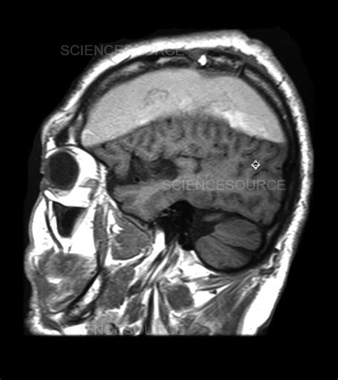 Photograph Mri Subdural Hematoma Science Source Images