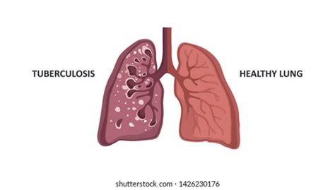 Tuberculosis Lungs Vs Healthy Lungs