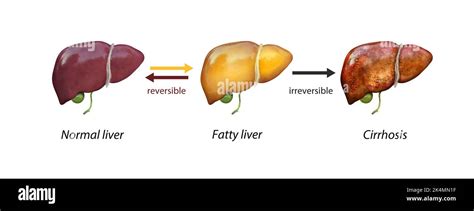 Liver cirrhosis drawing Fotos und Bildmaterial in hoher Auflösung Alamy