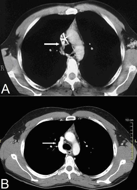 40 Year Old Man With Compensatory Dilatation Of The Azygos Venous Download Scientific Diagram