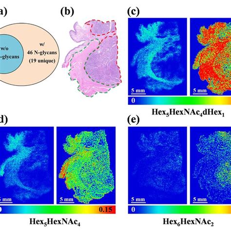 Maldi Ms Imaging Of N Glycans In Human Laryngeal Cancer Tissue Section Download Scientific