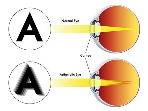 Best eye exercises for astigmatism – Artofit